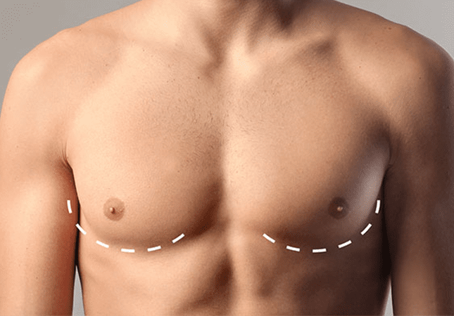 Gynecomastia